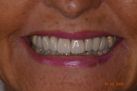 Facings in de Cosmetische Tandheelkunde